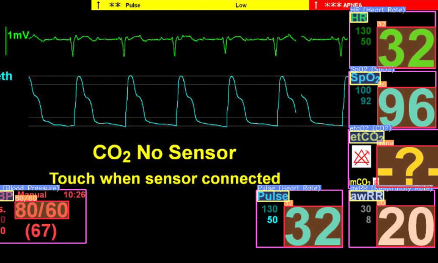 A hospital monitor screen showing heart rate, oxygen saturation, and blood pressure readings, with the message “CO2 No Sensor” in yellow—ideal for SIMStation AI-Powered Insights for Simulation Training when teaching capnography sensor issues.